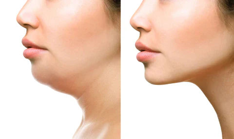Faja facial reductora