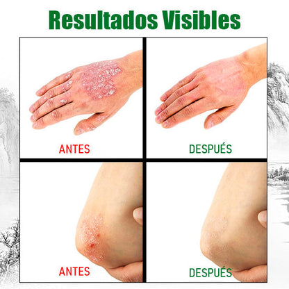Crema Antifúngica y Antipicazón – Tratamiento Natural para Tiña, Hongos y Psoriasis